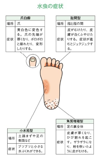 水虫の症状